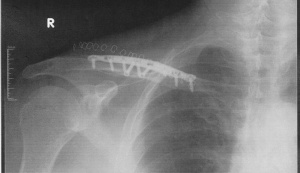 My Repaired Right Clavicle